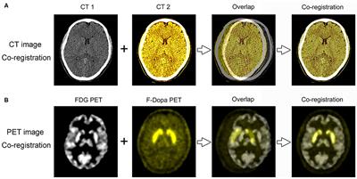 Co-registration Analysis of Fluorodopa and Fluorodeoxyglucose Positron Emission Tomography for Differentiating Multiple System Atrophy Parkinsonism Type From Parkinson's Disease